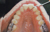 dent54